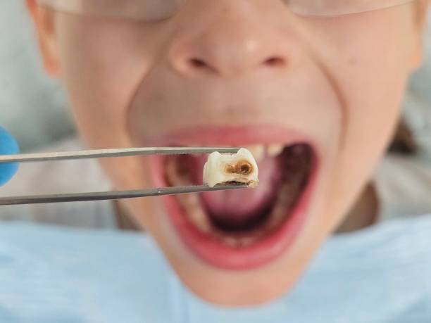 Best Broken or Cracked Tooth Emergency Dentist in Greensboro, NC