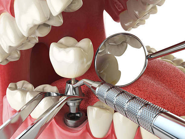 Best Emergency Dental Extractions in Greensboro, NC
